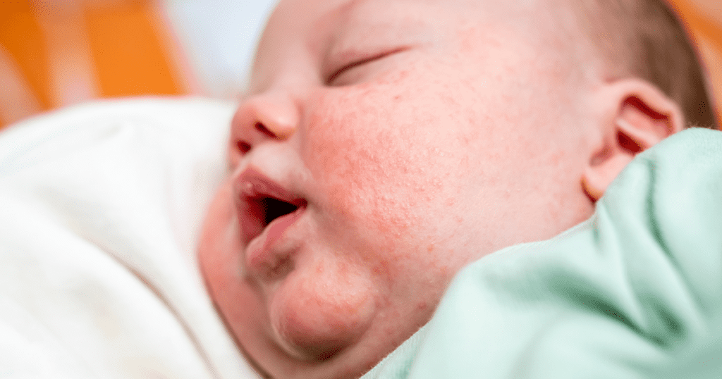 baby lying down with newborn acne on her face