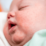 baby lying down with newborn acne on her face