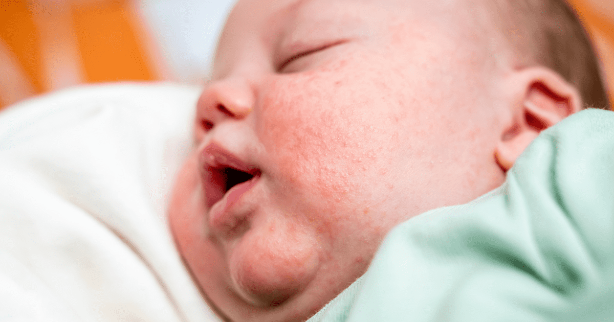 baby lying down with newborn acne on her face