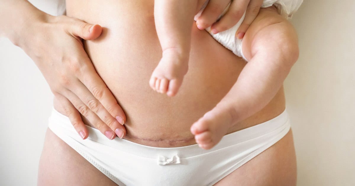 Mom with c-section scar holding baby, c-section recovery