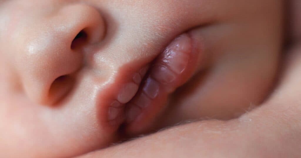 Newborn Lip Blister