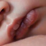 Newborn Lip Blister