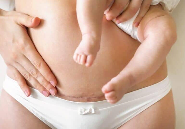 Mom with c-section scar holding baby, c-section recovery