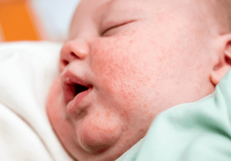 baby lying down with newborn acne on her face
