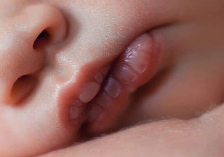Newborn Lip Blister