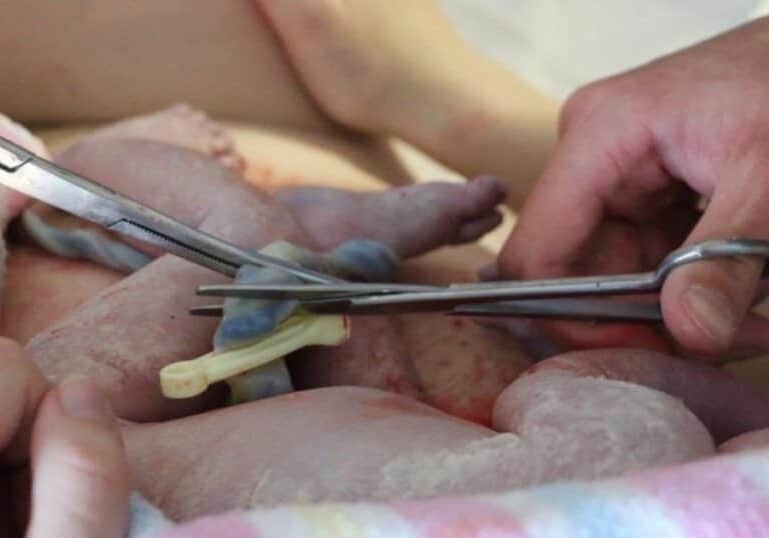 delayed-cord-clamping