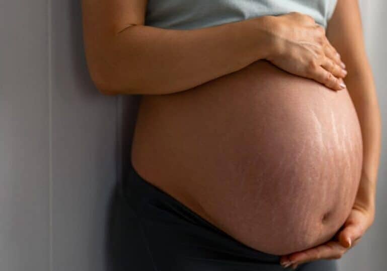 stretch marks during pregnancy